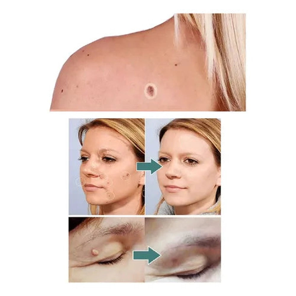 Verrugas y lunares pequeños en cara y cuello cubiertos con el parche transparente