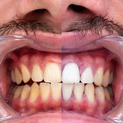 VioletSmile™ Pasta Dental Morada V34 Correctora de Color –